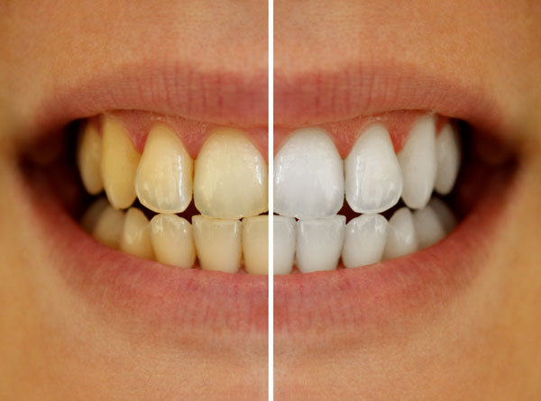 Einzelzahn oder komplette Zahnreihe, bestechend weiße Zähne durch Bleaching in der Zahnarzt Praxis van de Voort