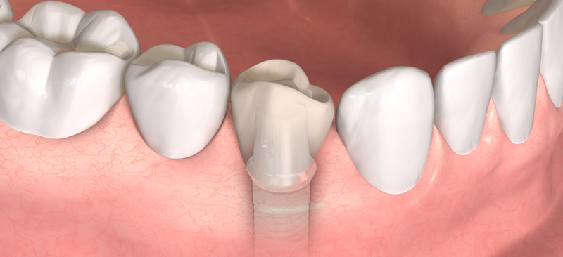 Das Implantat ersetzt die natürlich Zahnwurzel und gibt dem neuen Zahn sicheren Halt